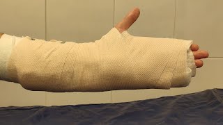 How to apply a hand cast  Using plaster of paris bandage  Ulnar gutter splint [upl. by Eseret965]