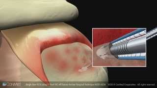 ConMed Linvatec Single Row Rotator Cuff Repair Using the Y Knot® RC Anchor Surgical Technique Anim [upl. by Ynnal658]