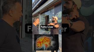 Fatty liver youtube youtubeshorts [upl. by Tove]