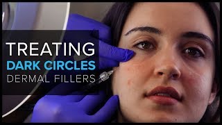 Treating Dark UnderEye Circles With Dermal Fillers at Mabrie Facial Institute [upl. by Blankenship]