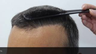 Hair Transplant Result Hairline Clinic Ankara Hair Transplant Turkey [upl. by Othelia557]