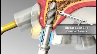 Guía quirúrgica en implantes dentales  Implantes NEODENT [upl. by Akyssej839]