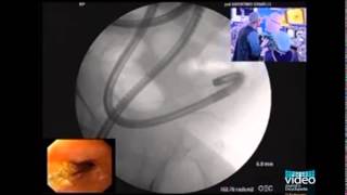 Enteroscopic Balloon Dilation of Multiple Ileal Strictures in Suspected Crohns Disease [upl. by Alekehs]