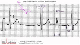 Interval Measurements 64  ECG  EKG Interpretation  BASIC [upl. by Moriyama215]