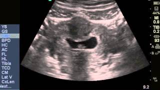 Early Intrauterine Pregnancy IUP [upl. by Ludwog563]