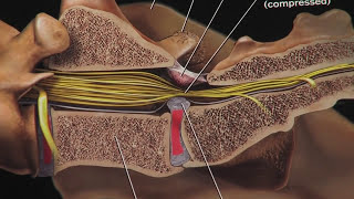 Intervertebral Disc Disease IVDD in Dogs Slipped Discs [upl. by Soble435]