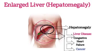 Enlarged Liver or Hepatomegaly  Signs and Symptoms Causes  Risk Factors  Treatment [upl. by Eseeryt]