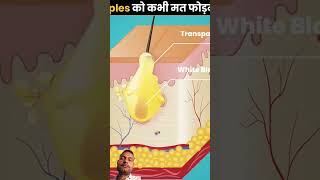 आपको कभी ना कभी पिंपल्स हुआ होगा knowledge thefact new ytshorts youtubeshorts amazing trend [upl. by Lelia720]