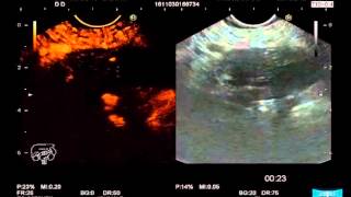 EUSGuided FineNeedle Aspiration for the Diagnosis amp Staging of Pancreatic Masses [upl. by Ahsyia142]