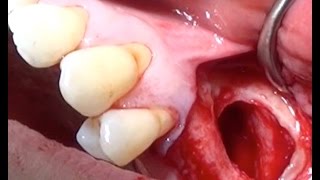 Maxillary Sinus liftSurgical Video [upl. by Ahsirt219]