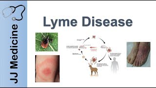 Lyme Disease  Pathophysiology Signs and Treatment [upl. by Eniliuqcaj773]