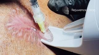 Intralesional steroid injections for keloid scars on the body rejuvenceclinic91 [upl. by Peednus]