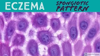 EczemaAtopic Contact Dermatitis etc Spongiotic Dermatitis Pattern  Inflammatory Dermpath Basics [upl. by Acirem]