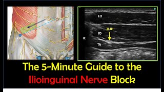 Ilioinguinal Nerve Block  A HowTo Guide [upl. by Utter]