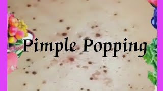 Pimple amp Blackheads Popping  52 [upl. by Arehc]