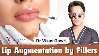 Lip Augmentation by Fillers  Dr Vikas Gawri  Kyra Clinic in Ludhiana Punjab [upl. by Leduar]