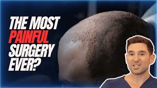 How Painful is a Hair Transplant Is it the Most Painful Procedure 😰 [upl. by Eatnahs]