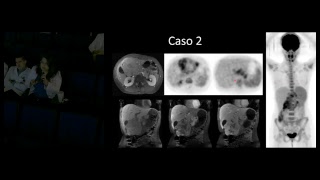 PETCT en carcinoma hepatocelular fibrolamelar y hepatoblastoma Dr Adiel Medrano [upl. by Moorefield355]