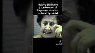 meige s syndrome combination of blepharospasm and orofacial dystonia [upl. by Acimak]