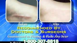 Scars  Scar Treatment  Scar Care  Dr Blaines Complete ScarCare Treatment [upl. by Arrek173]