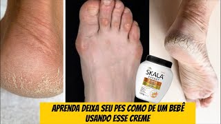 Aprenda Deixar Seus Pés Como de um Bebê usando esse creme SKALA [upl. by Anyalram]