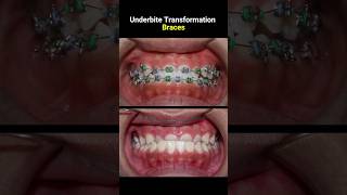 Underbite braces transformation braces orthodontist dentist bracket [upl. by Owiat]