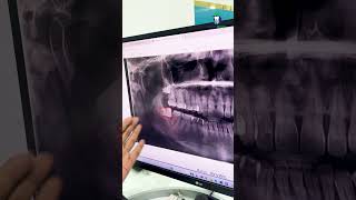 வலிக்காத ஞானப் பல்லையும் எடுத்து விடுங்கள்  Preventive Extraction of Wisdom Tooth  Denta Kings [upl. by Notliw]