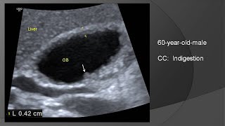 Adenomyomatosis of gallbladder [upl. by Anselmo]