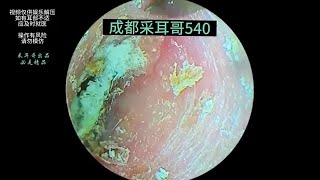 Treating moldy cerumen on the ear canal and eardrum ｜ 540 [upl. by Thomson198]