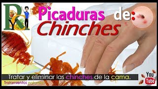 🕷️🐛 Picaduras de chinches  Piquetes de chinches  Como eliminar chinches de la cama picaduras 🛏️ [upl. by Kavanagh]