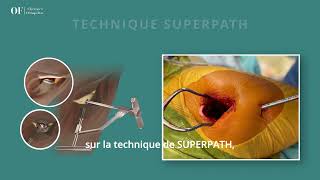 Prothèse totale de hanche par technique mini invasive Superpath présentation par le Dr OFontes [upl. by Letnuahc412]