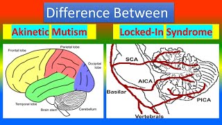 Difference between Akinetic Mutism and Lockin Syndrome [upl. by Eeralih]