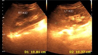 Fatty infiltration of the liver  Kidney Stone [upl. by Bortman]