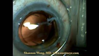 Open sky pupilloplasty cornea transplant IOL reposition [upl. by Dollie]