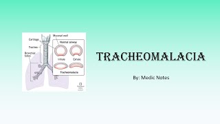 Tracheomalacia  clinical features investigation treatment and management [upl. by Xila]