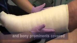 Correct way to apply toe and multilayer bandaging to Lymphoedema patients [upl. by Ennaeerb]