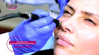 احدث تقنية لتنظيف العميق للبشرة والتقشير الماسي ف جلسة واحدة بالهيدرافشيل  hydra facial [upl. by Artimas]