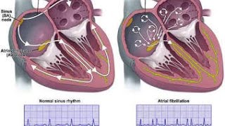 Atrial Fibrillation [upl. by Annay830]