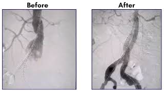 Endovascular Aortic Repair [upl. by Airotel245]