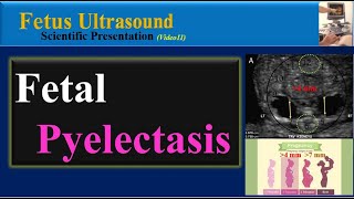 Fetus Ultrasound  Fetal Pyelectasis [upl. by Lareena]