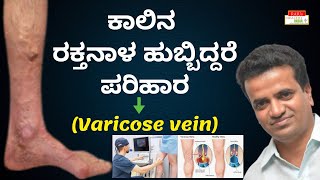 ಕಾಲಿನ ರಕ್ತನಾಳ ಹುಬ್ಬಿದ್ದರೆ ಪರಿಹಾರ Varicose Vein  Dr Raju Krishnamurty [upl. by Hsak885]