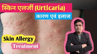 Skin Allergy Urticaria Cause And Treatment in Hindi  पित्ती का इलाज [upl. by Turne]