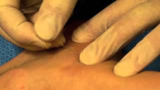 Dry needling for treatment of plantar fasciitis [upl. by Edan]