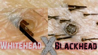 Blackhead and Whitehead on the ScalpSatisfying ExtractionClose Up [upl. by Sitsuj978]