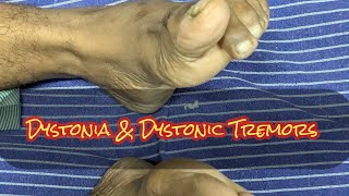 Dystonia Dystonic Tremors Extrapyramidal manifestations STRIATAL TOE [upl. by Bensen]