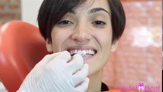 Applicazione Faccette Dentali  Torino [upl. by Sadoff]