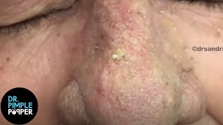 OVER 8 Minutes of SATISFYING Soft Pops Dr Pimple Popper [upl. by Elauqsap924]