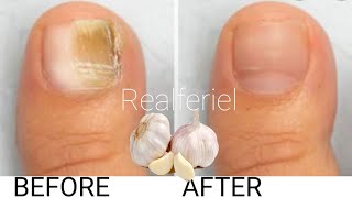 Soigner la mycose des ongles naturellement  Vous devez tester cette astuce [upl. by Naras]