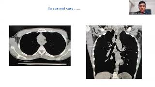 Central Airway Obstruction [upl. by Nnylsia]