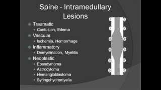 Localization of Spinal Masses  Introduction [upl. by Alison]